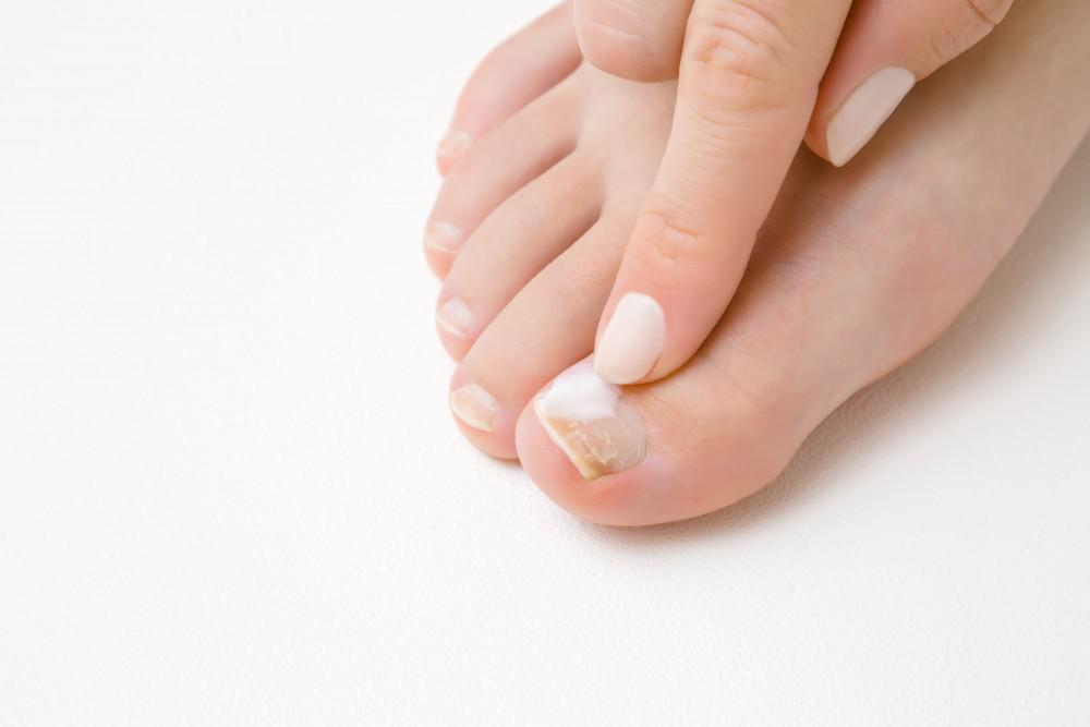 toenail laser treatment